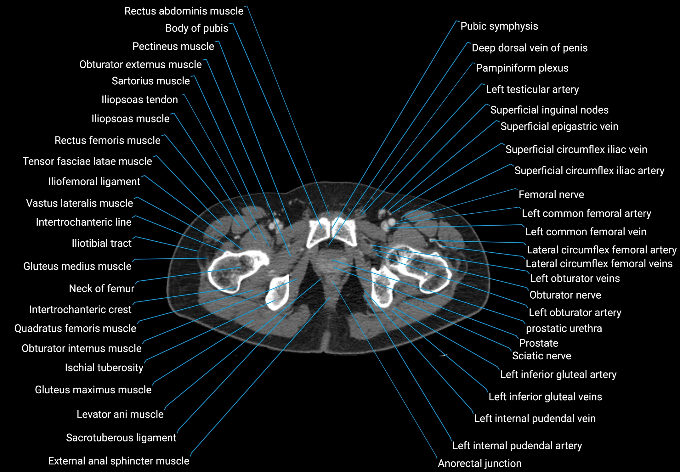 CT male pelvis axial cross sectional anatomy labelled radiology image -00199.webp